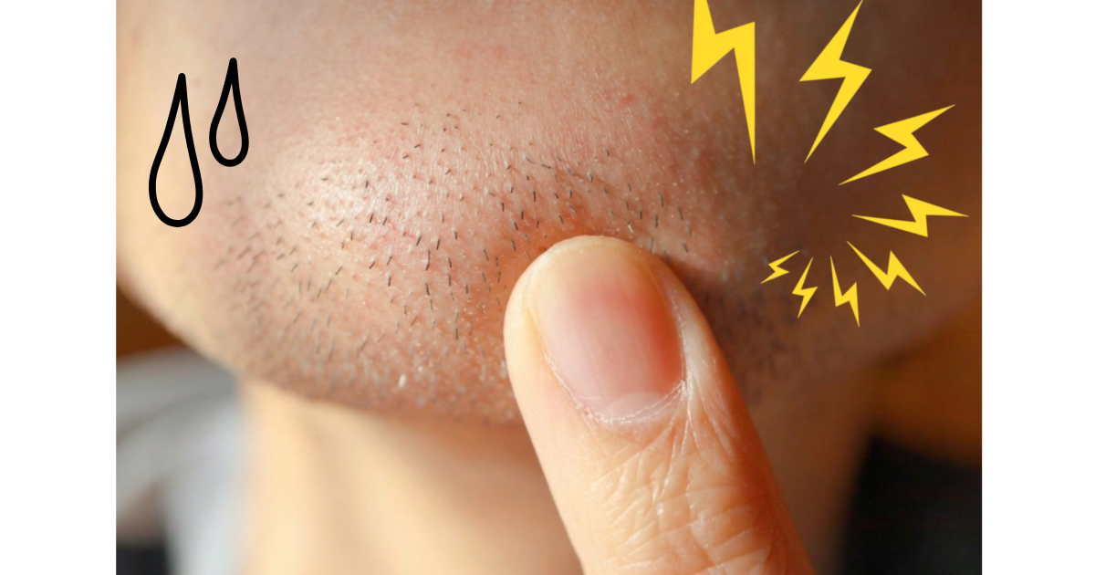 毛穴やヒリつきが気になる男性の肌